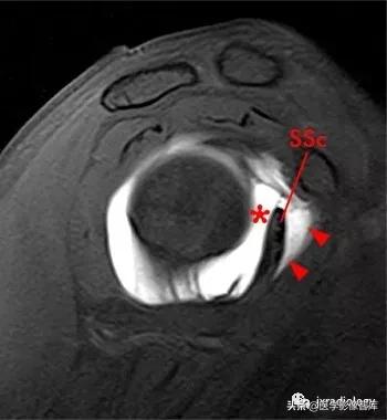 肩关节滑膜解剖,肩关节周围肌肉解剖