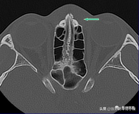 「鼻骨彩图」鼻骨CT解剖及骨折影像学诊断