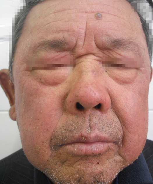 光过敏/多形性日光疹