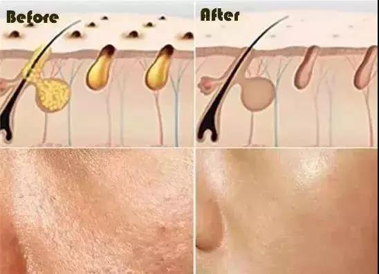 春季脸上干燥泛红发痒起皮怎么办,脸上干燥起皮泛红用什么补水