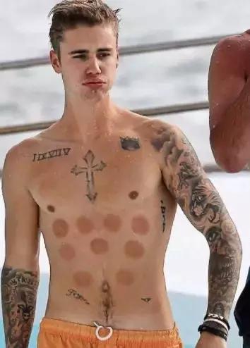 老外有多迷恋拔火罐,外国人吐槽中国拔罐