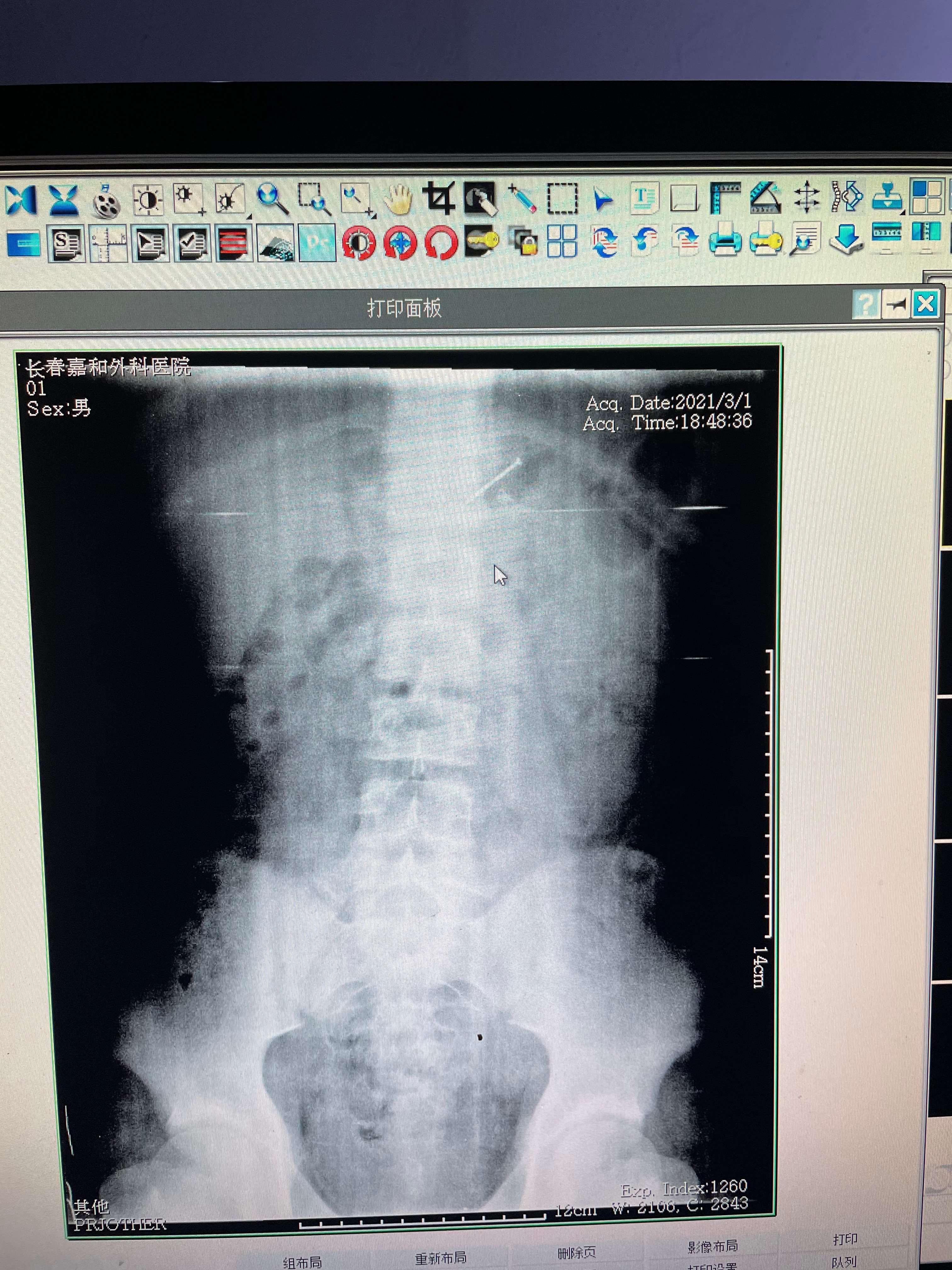 危险！长春13岁男孩把两根4厘米长钢钉含在嘴里玩不慎误吞