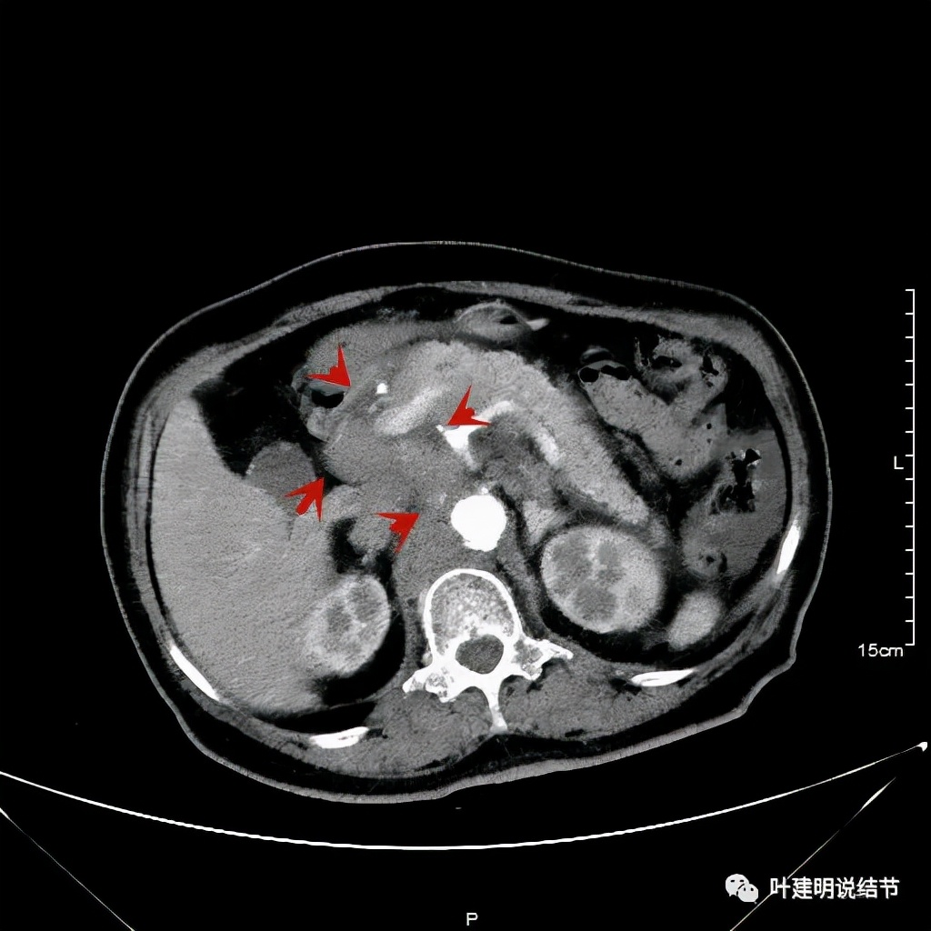 特瑞普利单抗食管癌成功案例,特瑞普利单抗治疗食管癌效果好吗