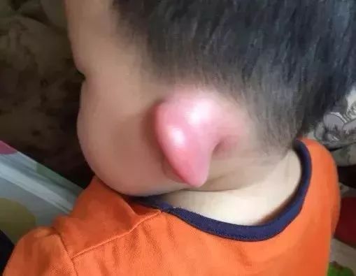 被蚊子咬了是直接拍死还是赶走,被蚊子咬后该干什么