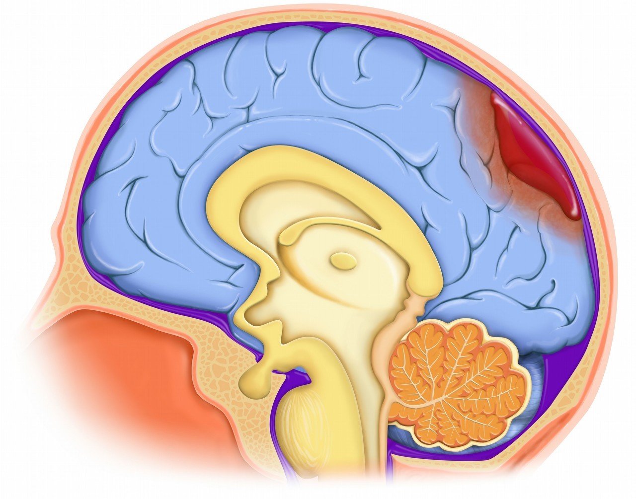 脑出血怎么处理最有效,脑出血在家紧急处理