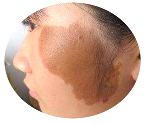 小孩胎记一般是什么颜色,宝宝身上各种颜色胎记需要治疗吗