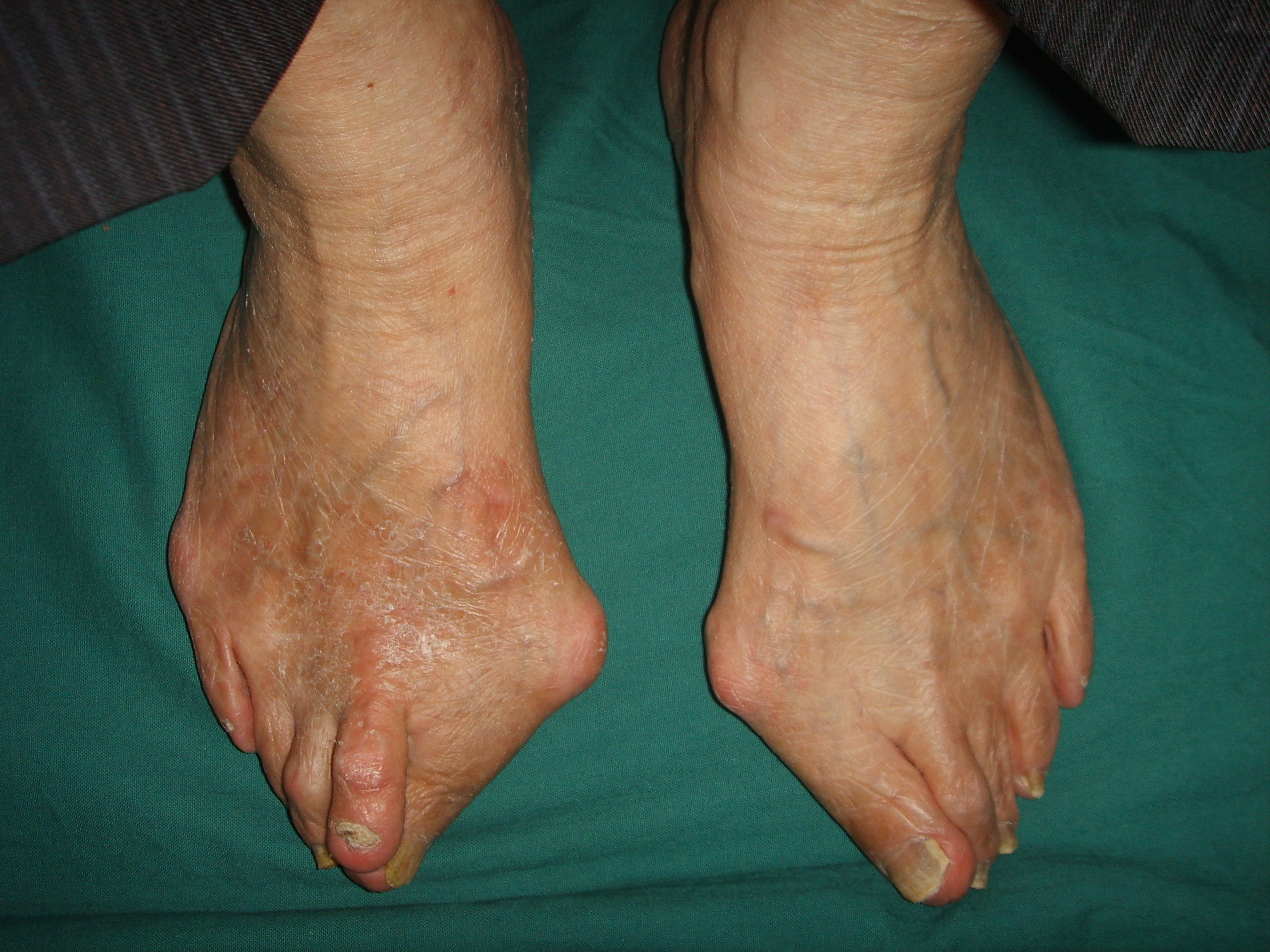 脚拇指外翻手术后还会遗传吗,遗传性拇外翻需要做手术么