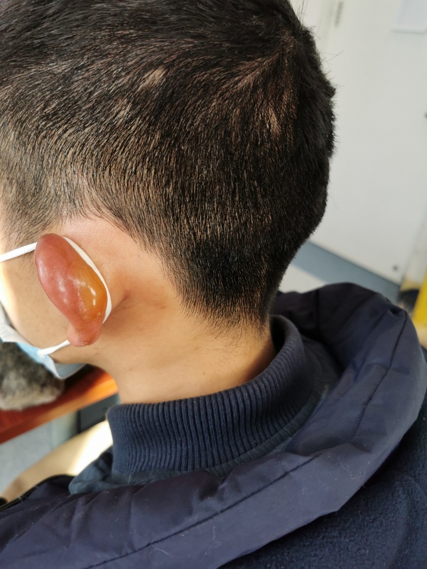 冻伤了是去烧伤科处理吗,烧伤科看冻伤吗