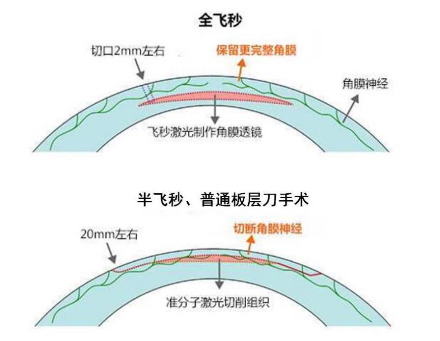 smile全飞秒近视手术,全飞秒准分子激光近视眼手术