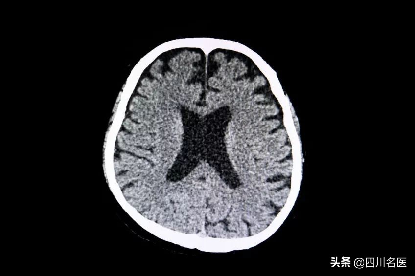 血脂高的人中脑梗心梗概率最大,血脂高8.5得心梗脑梗的几率有多少