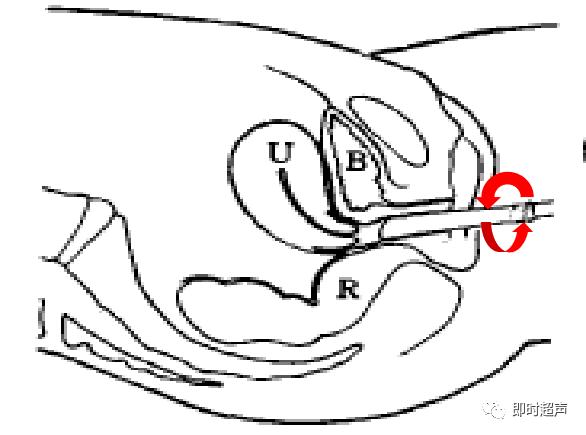 膀胱超声图解大全,膀胱超声解剖及常见病变超声表现