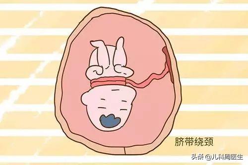 胎儿脐带绕颈怎么绕出来,胎儿脐带绕颈2圈