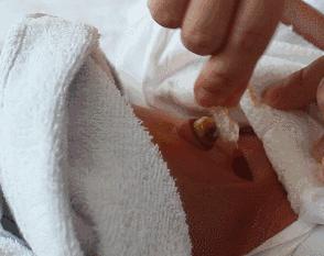 新生儿湿疹又咳嗽,新生儿湿疹每天早上起床加重