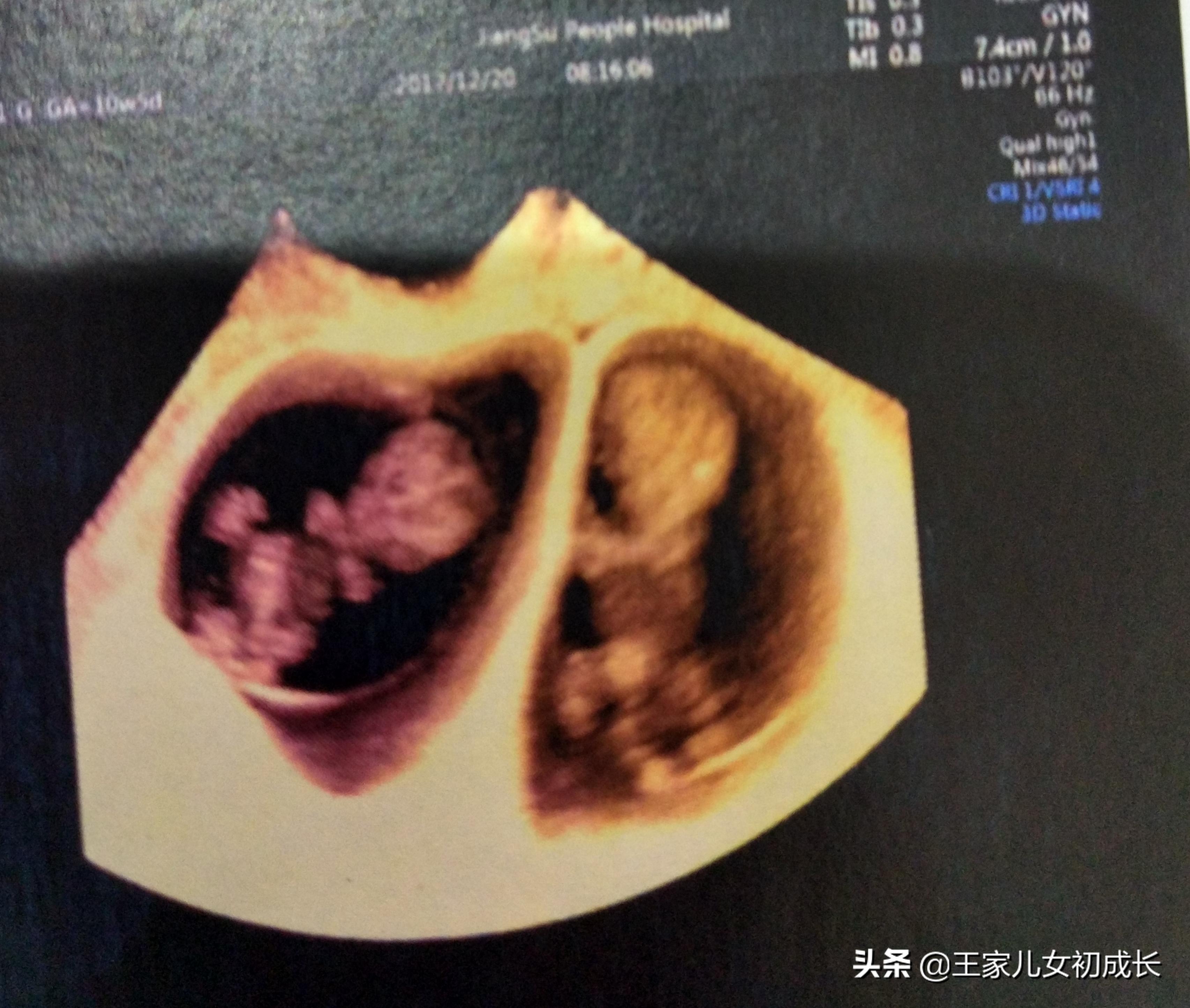 我的试管之路完整视频,试管之路的艰辛