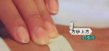 输液的手为什么会酸,输液的手一直青紫