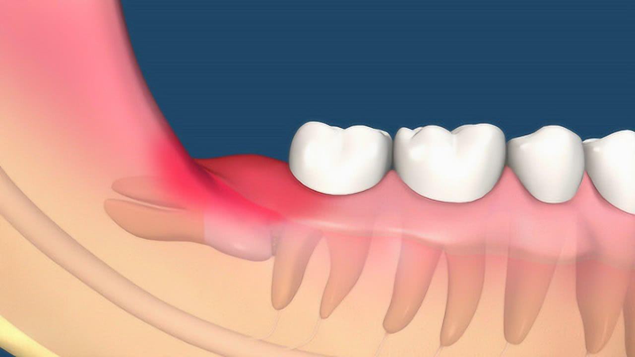 智齿有哪些可怕的事,智齿为什么容易引起发炎