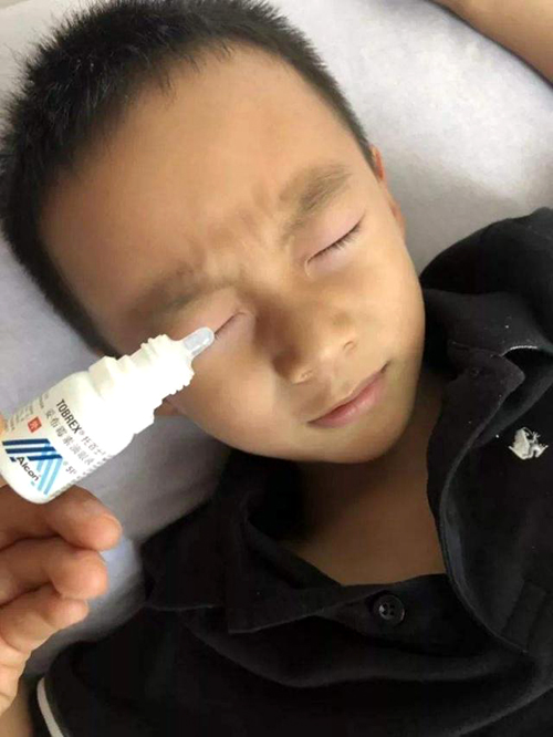 儿童使用502胶把自己眼睛粘住了,一滴502胶水进入眼睛会怎样