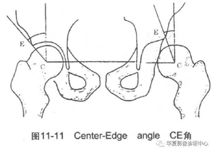 先天性髋关节脱位饮食,先天性髋关节脱位属不属于残疾人