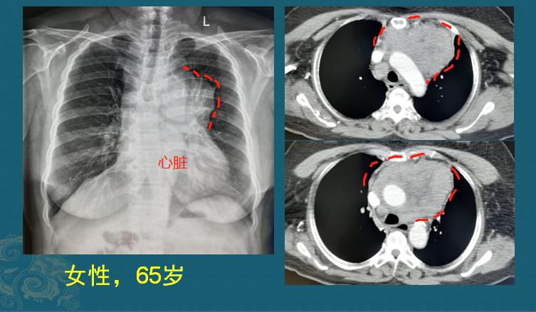 健康体检就像下海打渔,癌细胞有漏网之鱼,绝户网成本太高了