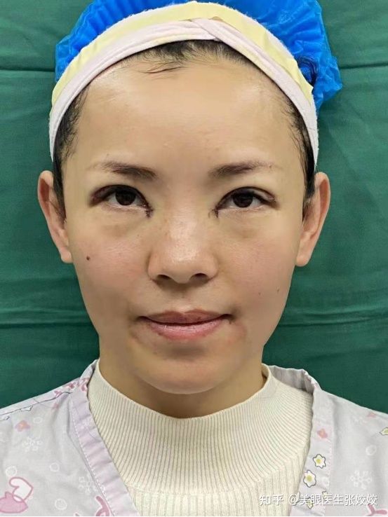 割双眼皮会影响运势吗,40岁割双眼皮效果图