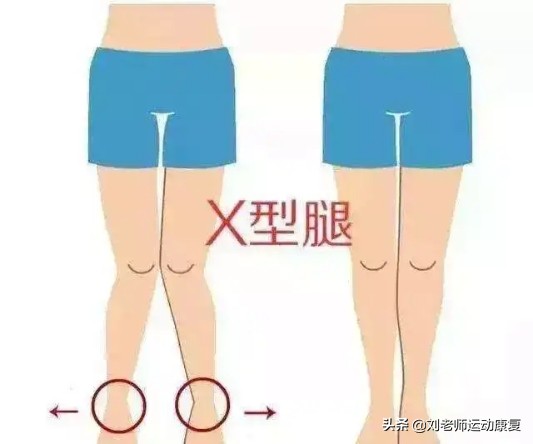 站立时两脚并不拢,交叉腿站立能矫正腿型吗