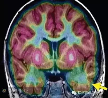 儿童癫痫CT表现,儿童各类癫痫脑电图特征