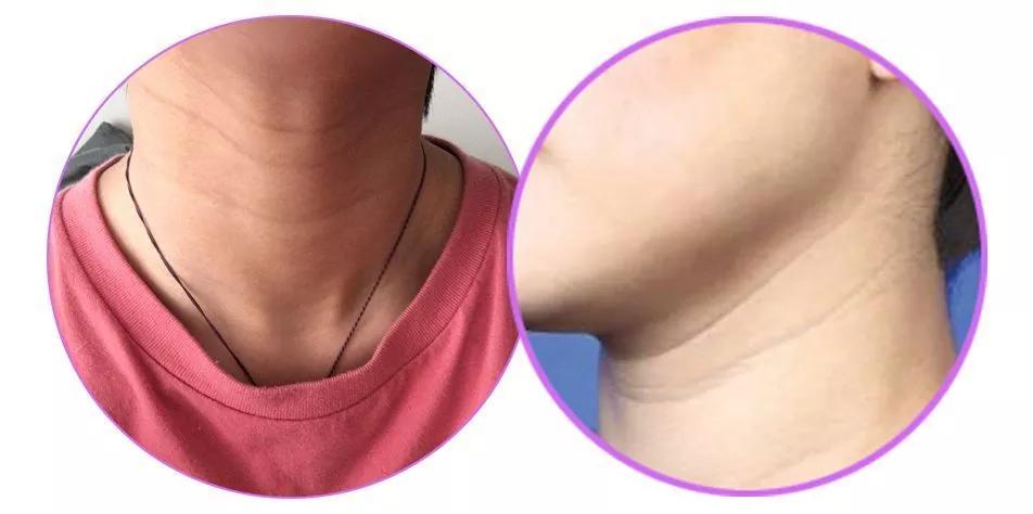 去脖子黑色素颈纹的最快方法,老年人脖子上的颈纹怎么遮挡