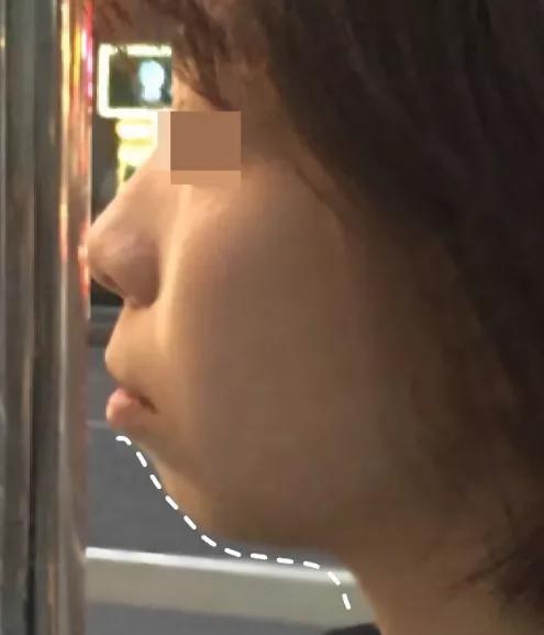 下巴短不尖怎么改善小窍门,下巴短没有后缩怎么改善