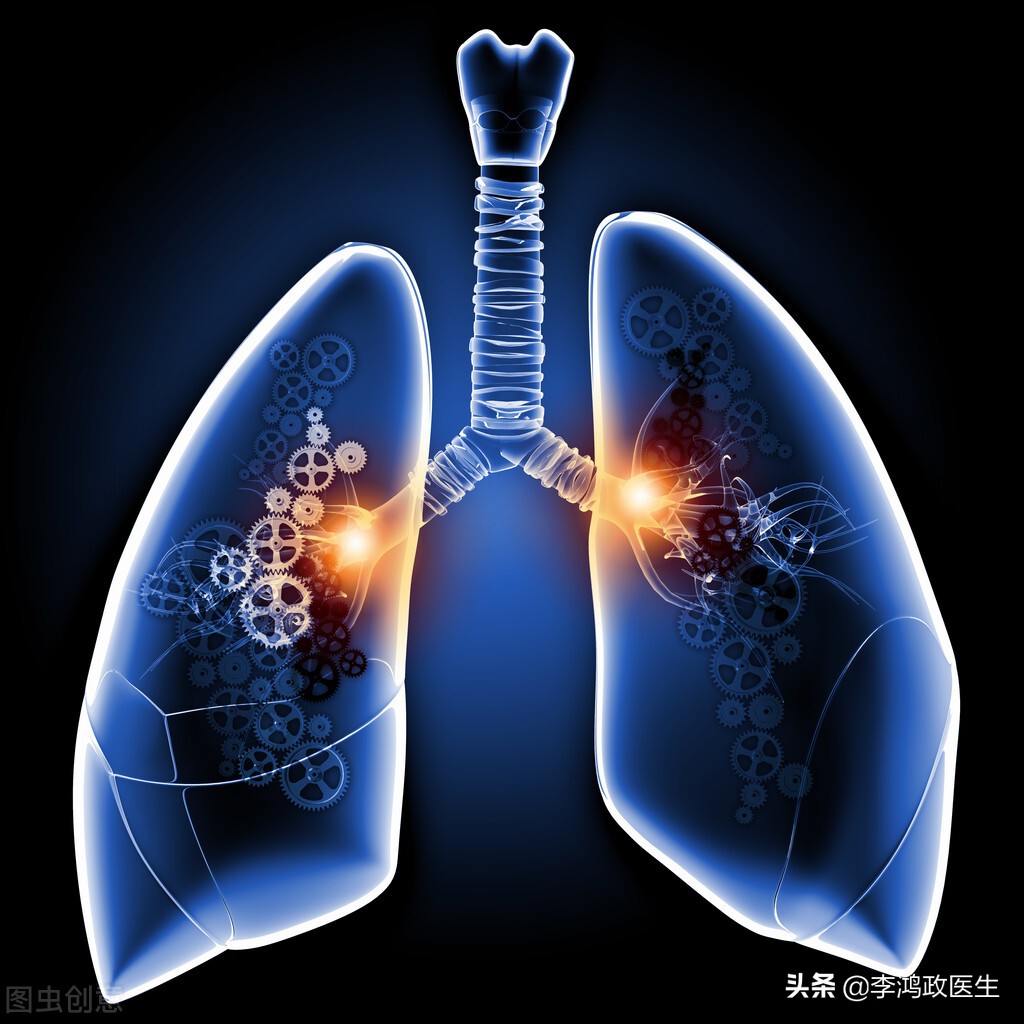 女子发烧用药后咽痛加剧，医生看脖子：不是甲亢，第一次看走眼了