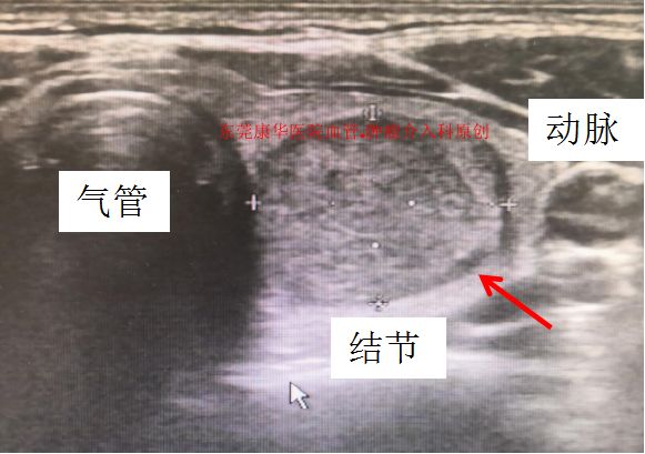甲状腺结节微创消融手术,甲状腺结节微创消融医保