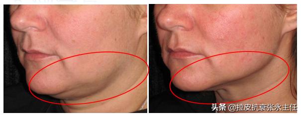 小切口拉皮手术可以维持多久,哪些人适合拉皮除皱术