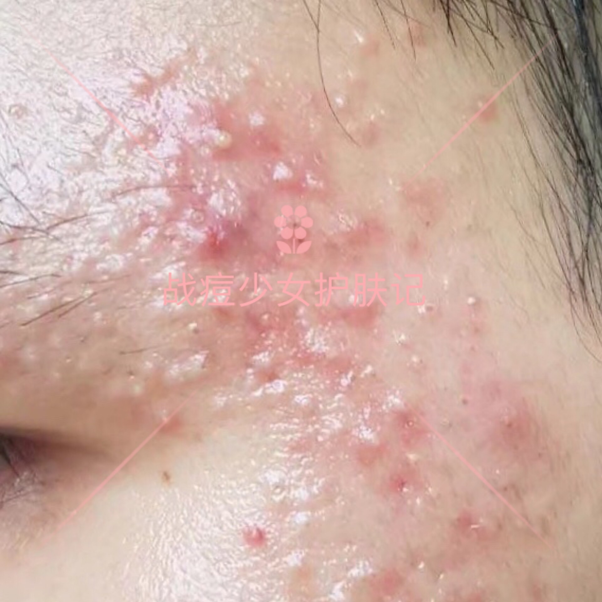 6种痘痘对号入座，1分钟教会你认清痘痘类型，对症战痘！