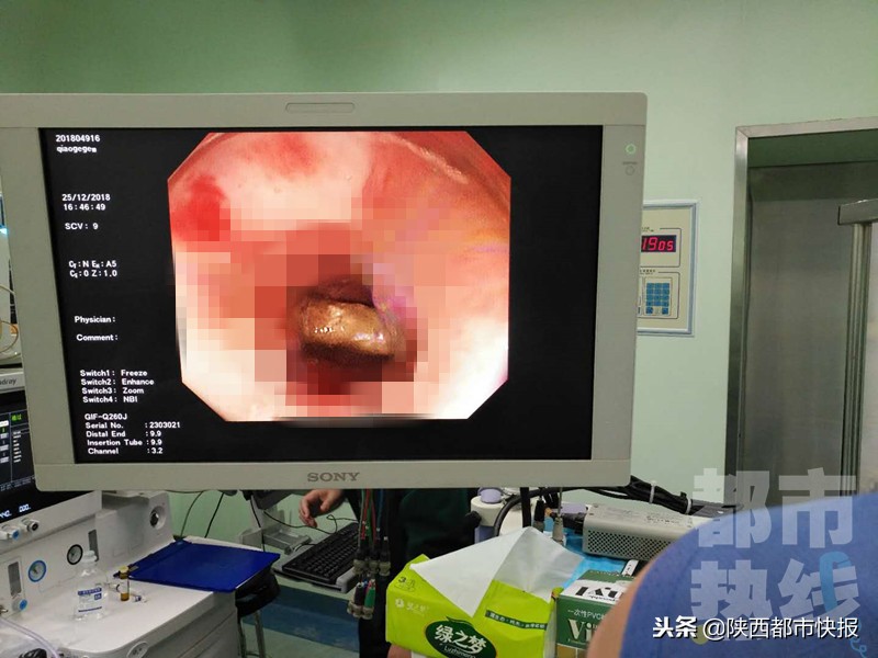 孕妇误食了枣核,孕妇不小心吞了一个红枣核要紧吗