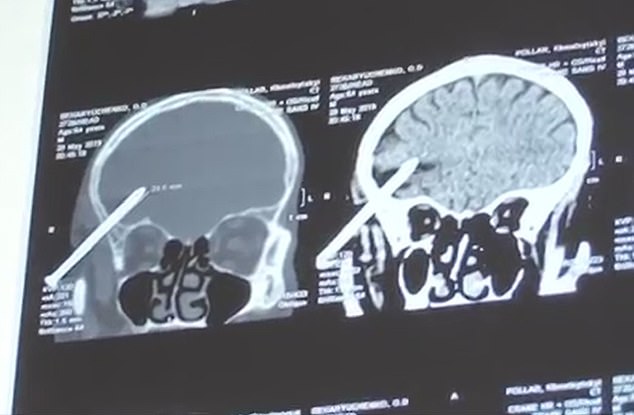 男子与家人激吵欲自杀，竟向头钉入2枚6厘米长钉，结果非同寻常