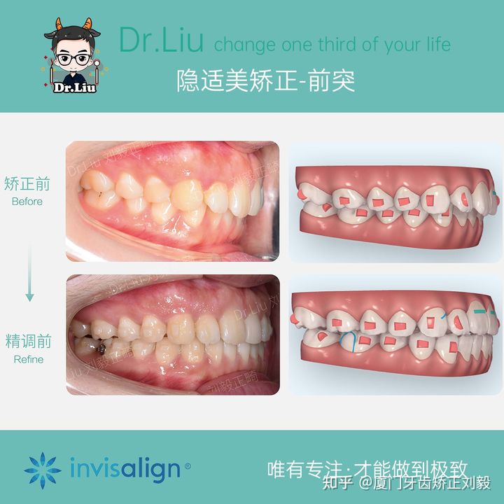牙齿矫正厦门口腔医院,厦门隐形龅牙矫正优惠