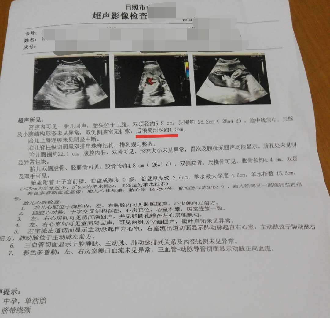 胎儿脑部积水怎么回事,怀孕胎儿脑有积水什么原因