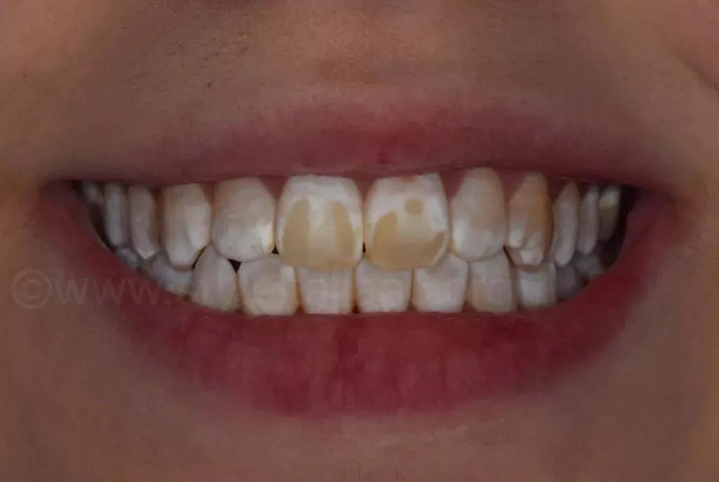 牙齿上出现白斑是怎么回事,牙齿上有白斑是什么原因