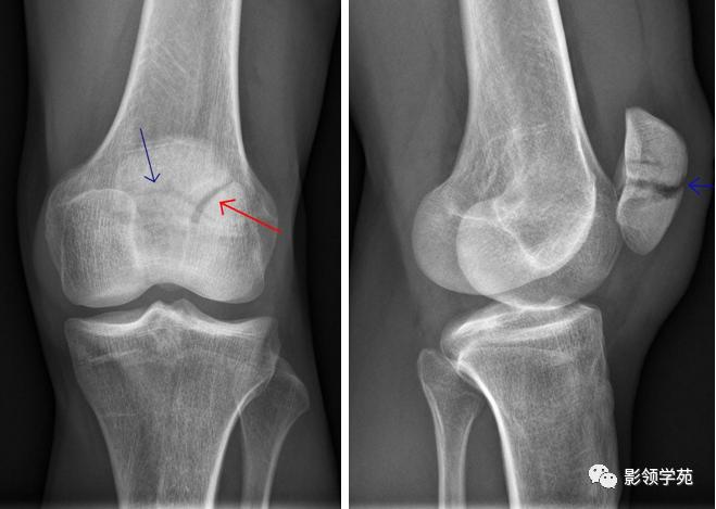 桡骨远端骨折引起尺骨变异,撕脱骨折一个月无明显骨痂形成