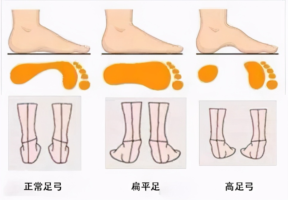 足弓塌陷的矫正动作懒人法,足弓改善动作