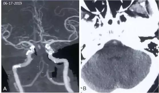 基底动脉狭窄介入指南,基底动脉重度狭窄用药用量