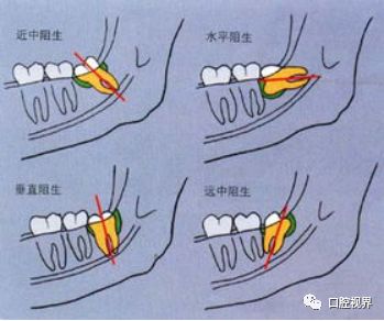 拔牙后的十大注意事项,月经期拔牙注意事项与禁忌症