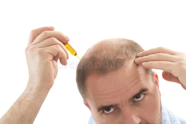 假性斑秃和真斑秃的区别,斑秃是什么病怎么解决