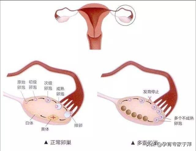 青岛助孕专家于萍:5大症状警惕“多囊”,有1招治疗需要您配合