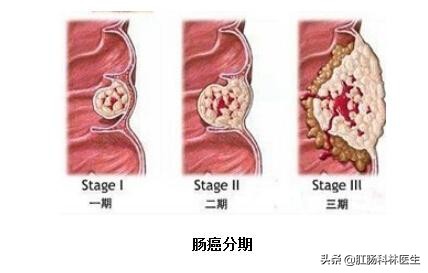 直肠癌不保肛手术得多长时间恢复,结直肠癌手术造口后多久恢复正常