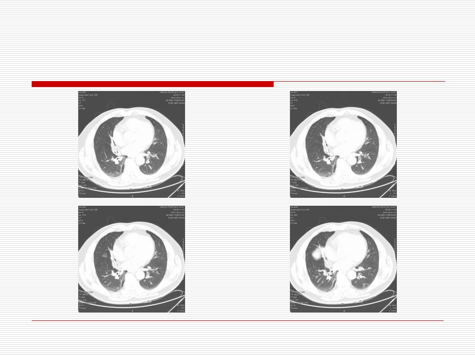 像炎症的肺癌能治好吗,医生说可能是肺癌也可能是炎症