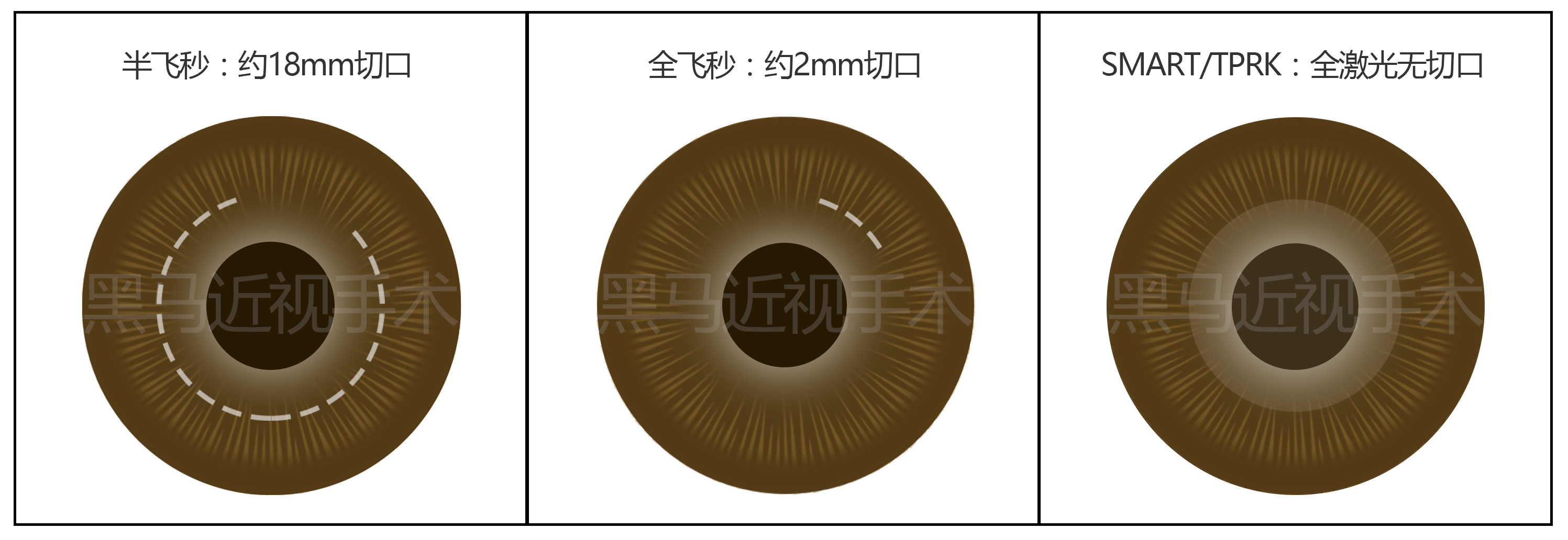 近视300度做激光手术会有后遗症吗,激光近视手术的后遗症有哪些知乎