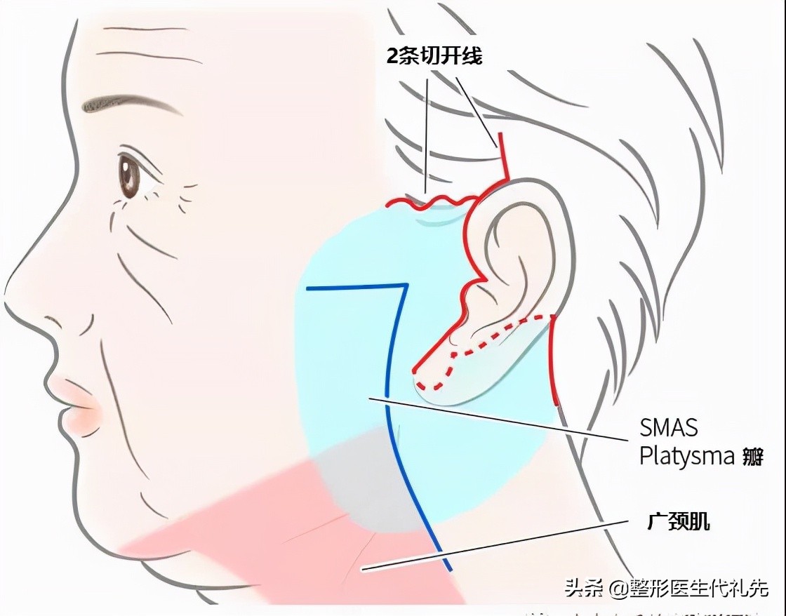 现在最流行的面部提升是什么项目,目前最先进效果最好的面部提升
