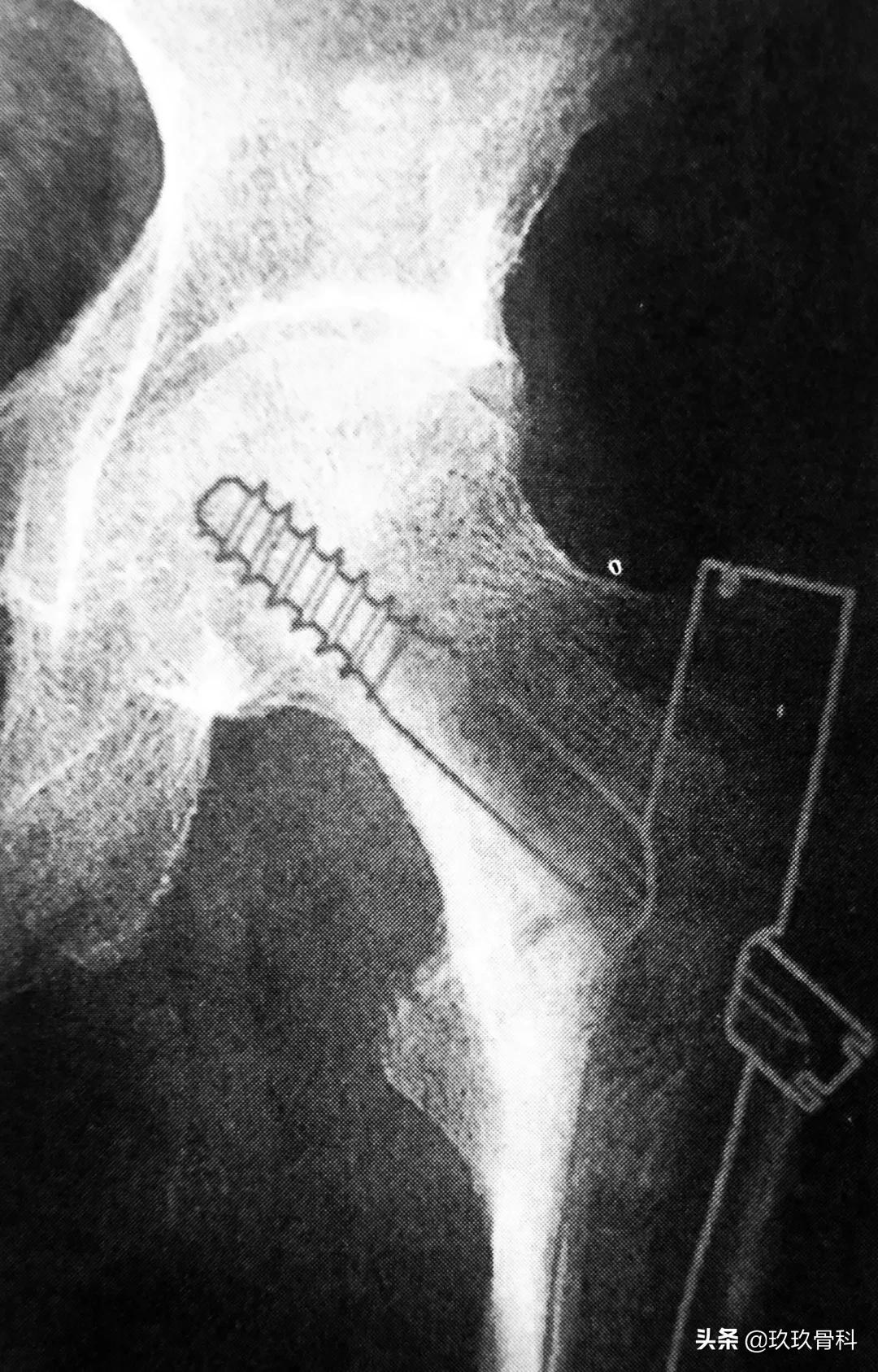 骨科用髓内钉什么材料,骨科髓内钉的作用