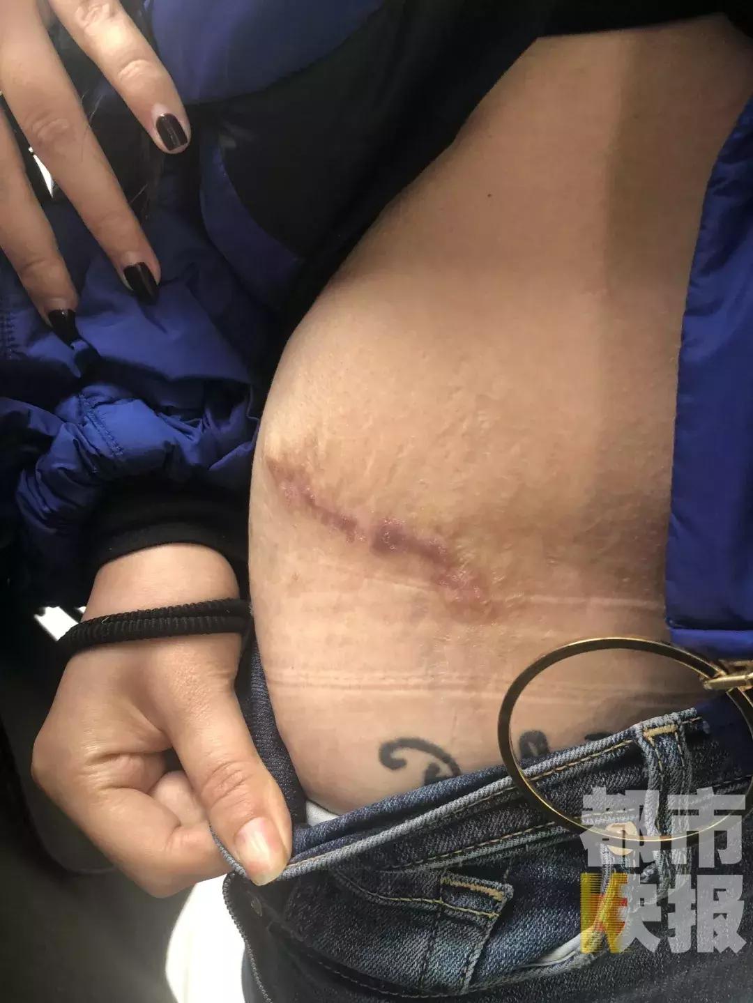 西安女子除妊娠纹,西安女子医院去妊娠纹