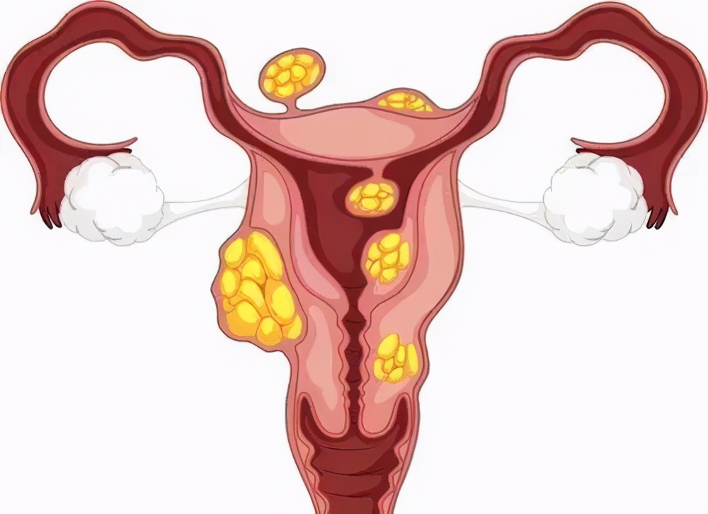 体检突然发现子宫肌瘤,发现子宫肌瘤怎么办